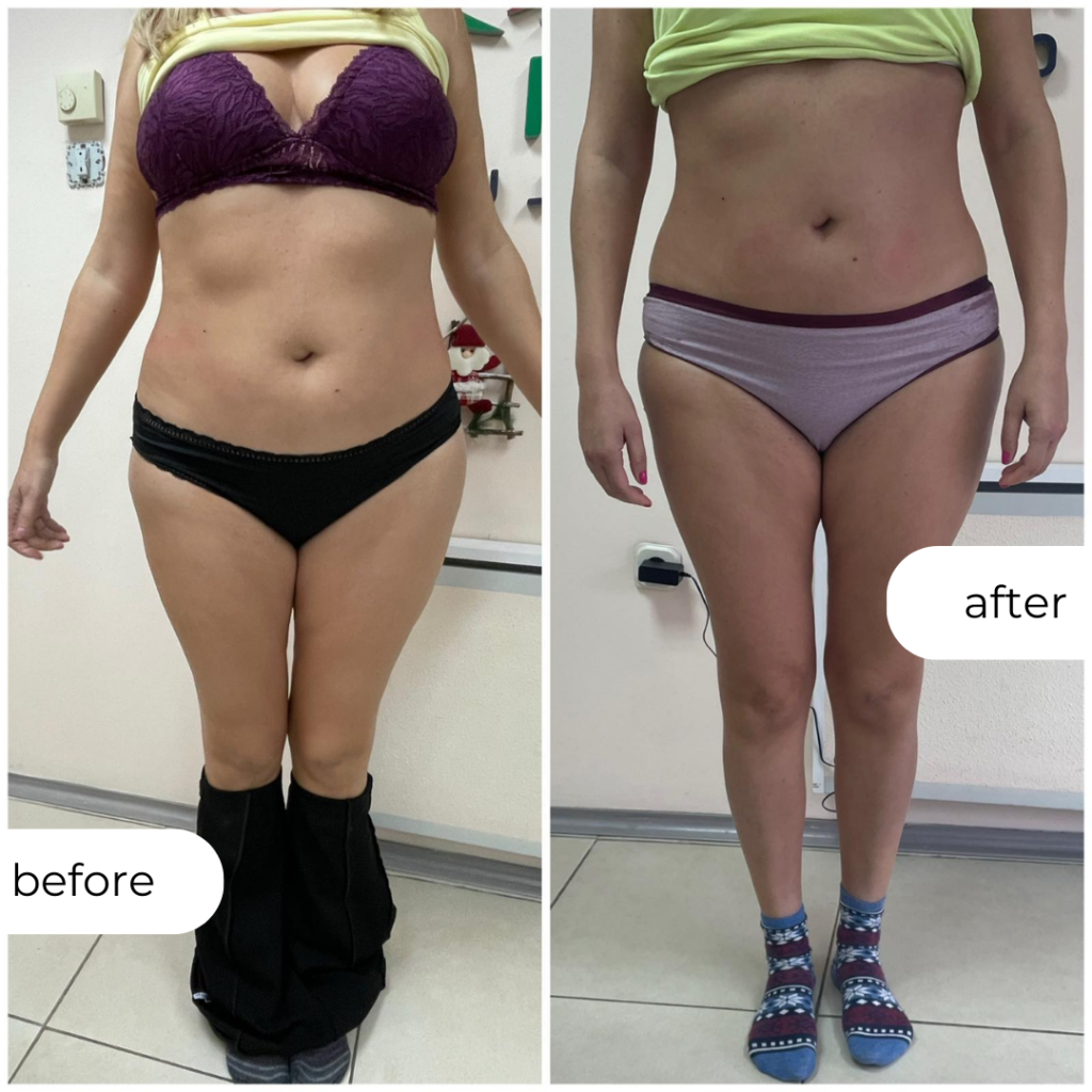 УЛТРАЗВУЧНА КАВИТАЦИЈА (4 ТРЕТМАНИ)