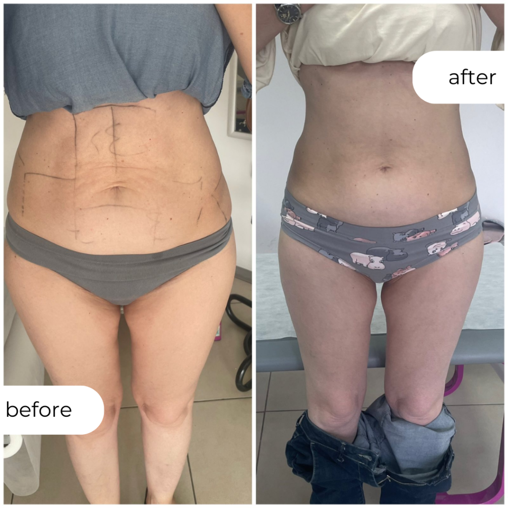 ХИФУ НА СТОМАК