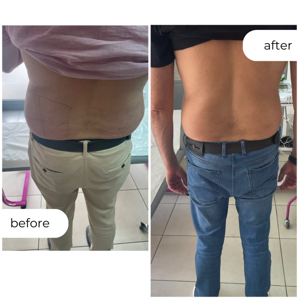 ЛИПОЛИЗА (РЕЗУЛТАТ 14 ДЕНА)