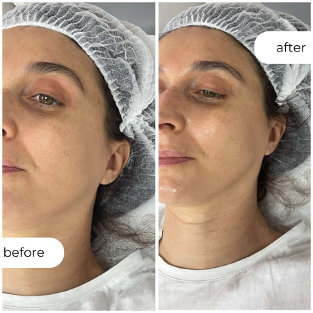 ХЕМИСКИ ПИЛИНГ TPRX