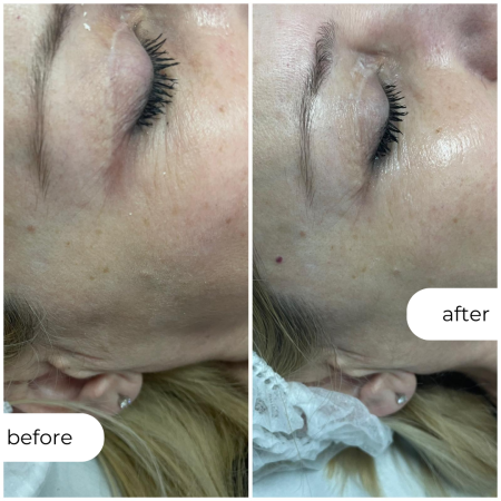 ПЕРИОКУЛАР ПИЛИНГ ОКОЛУ ОЧИ