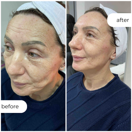 ЛАСЕР ЛИФТИНГ