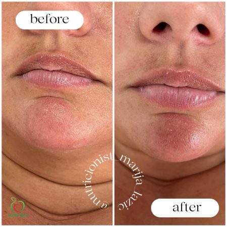 МЕЗОХИЈАЛУРОН ( УСНА И БРАДА)